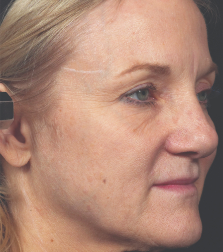 ameliyatsiz-yuz-germe-oncesi