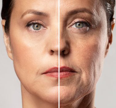 ameliyatsız yüz germe nedir